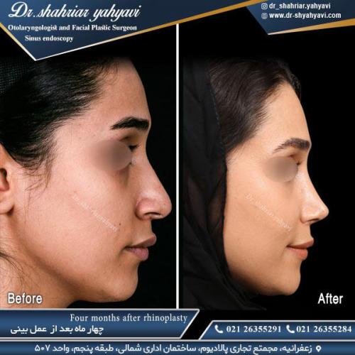 جراحی بینی 502