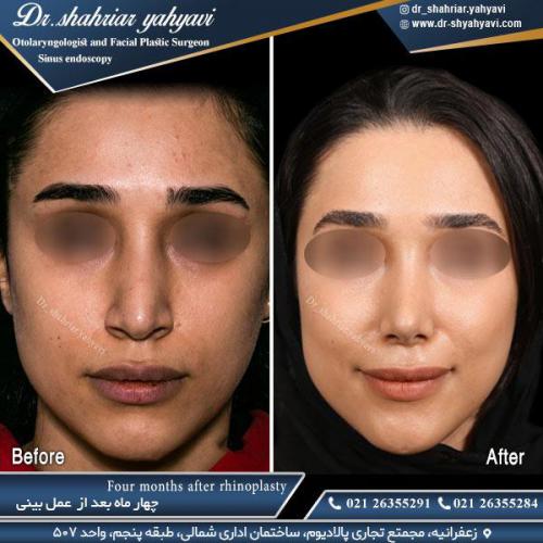 جراحی بینی 503