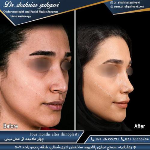 جراحی بینی 504