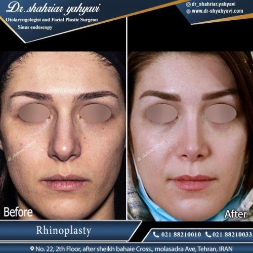جراحی بینی تهران 1