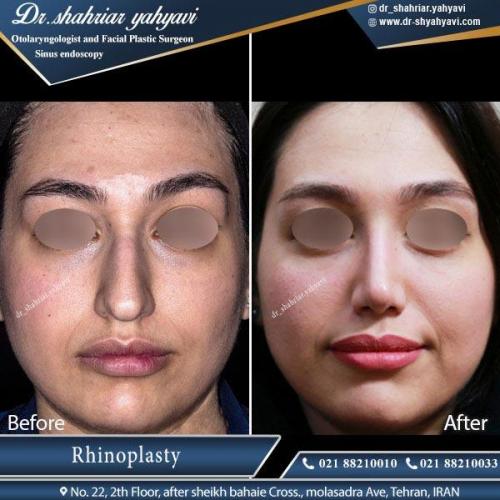 جراحی بینی تهران 12