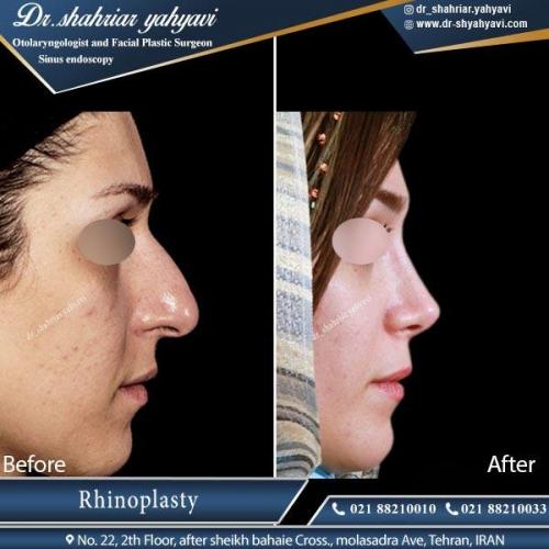 جراحی بینی تهران 2