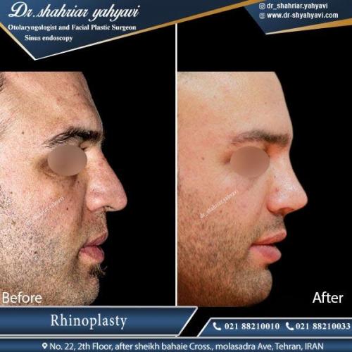 جراحی بینی تهران 3