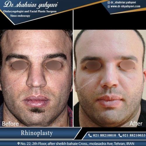 جراحی بینی تهران 4