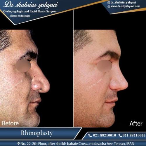 جراحی بینی تهران 5