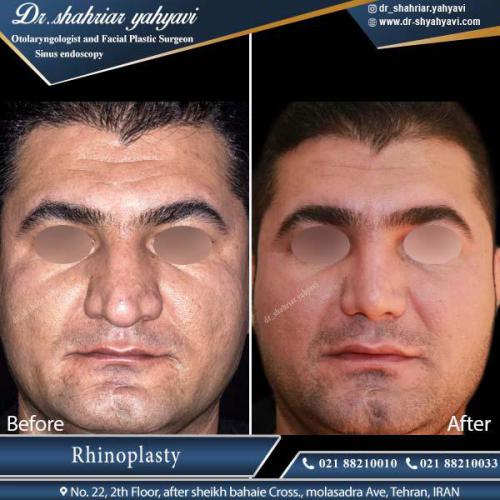 جراحی بینی تهران 6