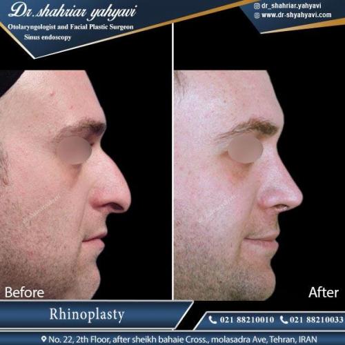 جراحی بینی تهران 7