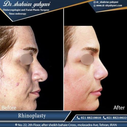 جراحی بینی تهران 8