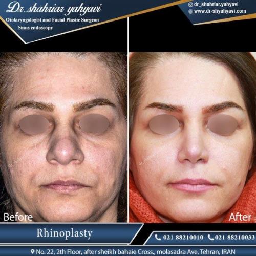 جراحی بینی تهران 9