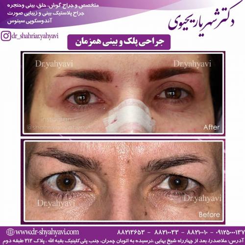 جراحی زیبایی بینی 32