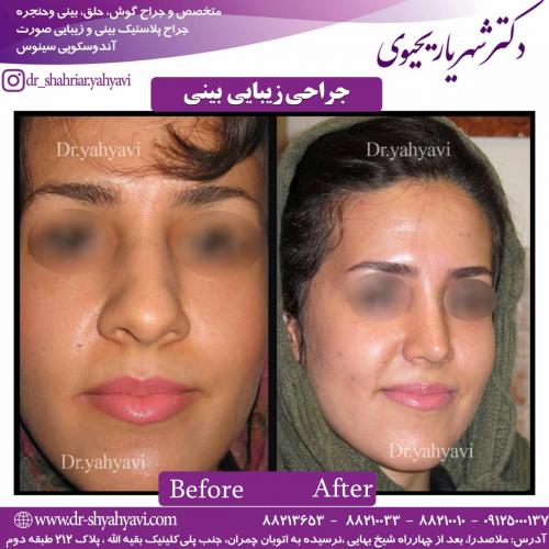 جراحی زیبایی بینی 34 (1)
