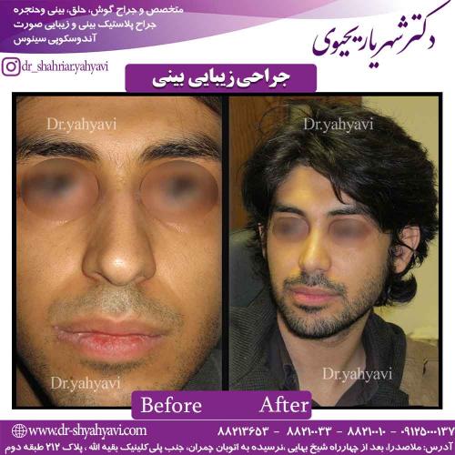 جراحی زیبایی بینی 43