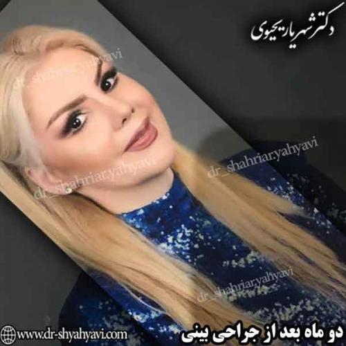 جراحی زیبایی بینی 45