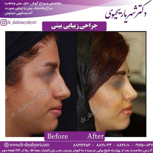 جراحی زیبایی بینی 50