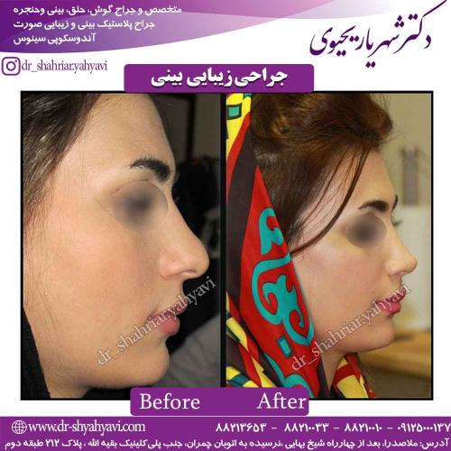 جراحی زیبایی بینی 53