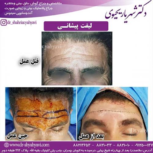 لیفت-پیشانی