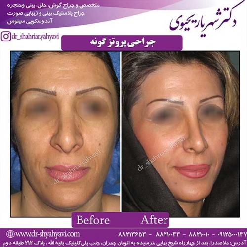 پروتز-گونه-1