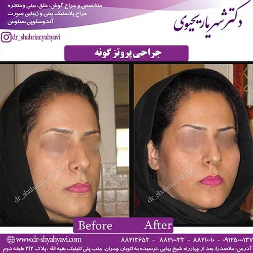 پروتز-گونه-2